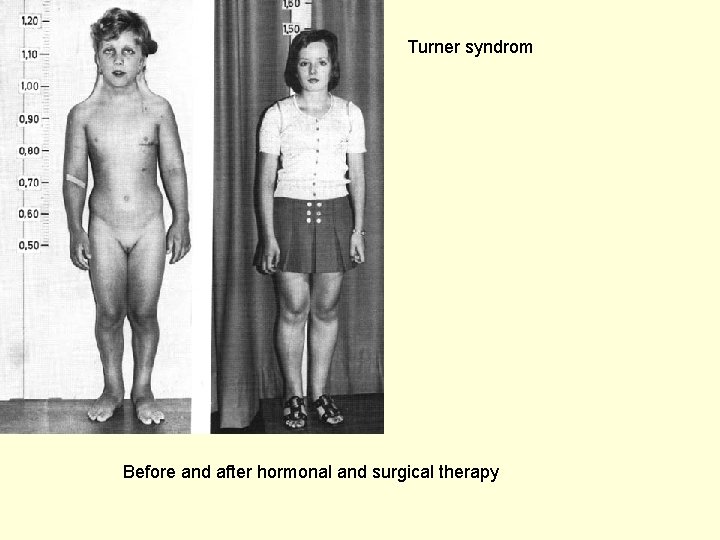 Turner syndrom Before and after hormonal and surgical therapy 