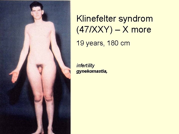 Klinefelter syndrom (47/XXY) – X more 19 years, 180 cm infertility gynekomastia, 