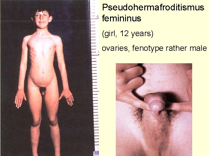 Pseudohermafroditismus femininus (girl, 12 years) ovaries, fenotype rather male 