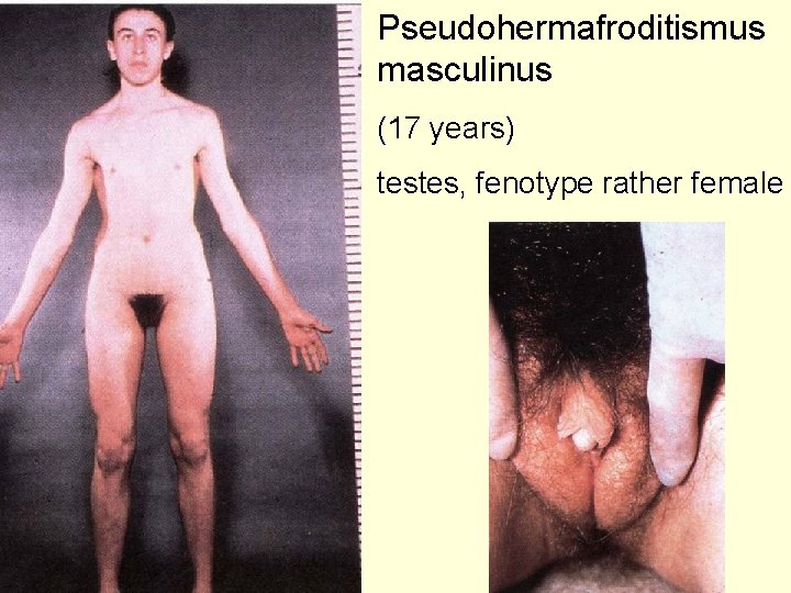 Pseudohermafroditismus masculinus (17 years) testes, fenotype rather female 