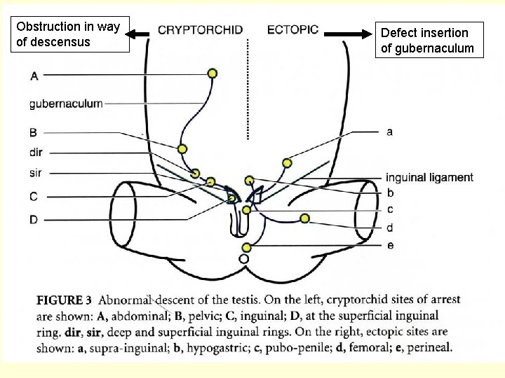 Obstruction in way of descensus Defect insertion of gubernaculum 