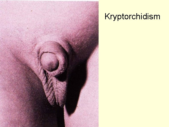 Kryptorchidism 