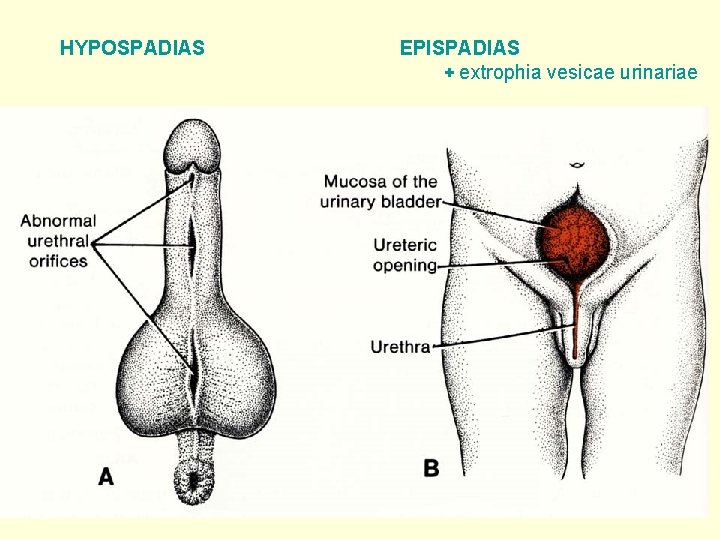  HYPOSPADIAS EPISPADIAS + extrophia vesicae urinariae 