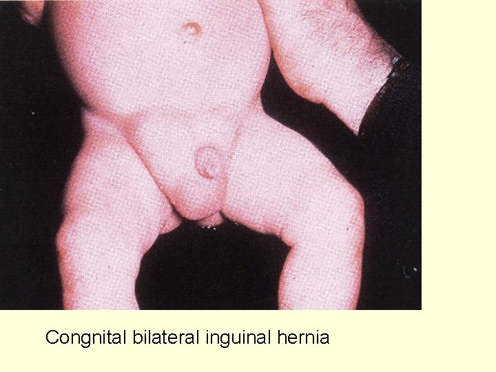 Congnital bilateral inguinal hernia 