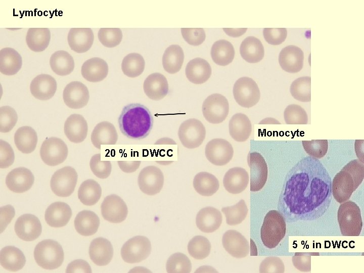 Lymfocyte Monocyte 20 % in DWCC 5 % in DWCC 