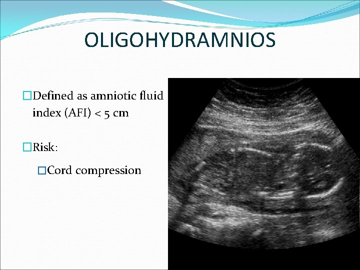 OLIGOHYDRAMNIOS �Defined as amniotic fluid index (AFI) < 5 cm �Risk: �Cord compression 