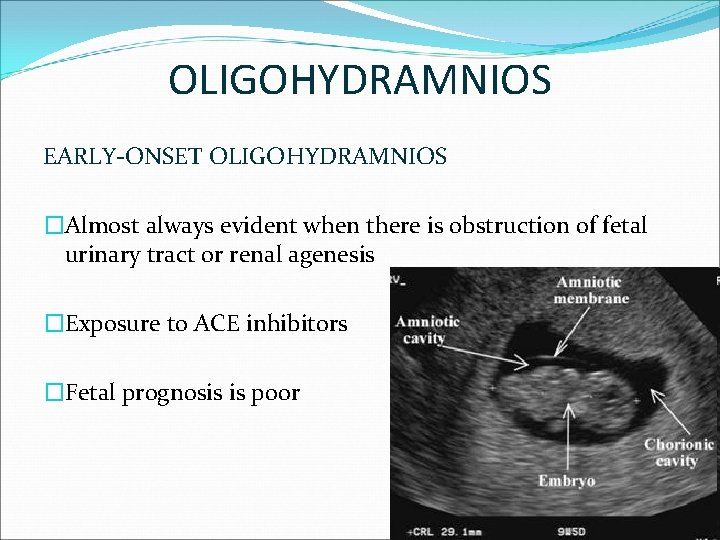 OLIGOHYDRAMNIOS EARLY-ONSET OLIGOHYDRAMNIOS �Almost always evident when there is obstruction of fetal urinary tract