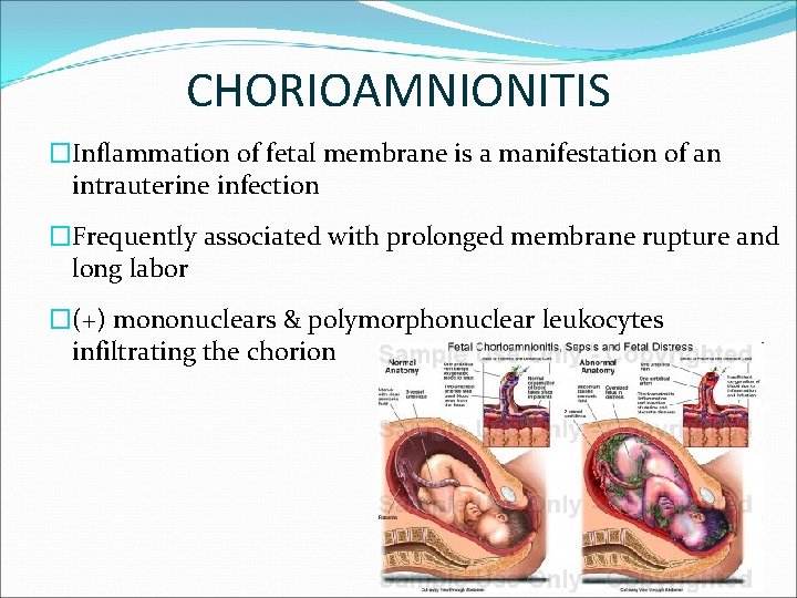 CHORIOAMNIONITIS �Inflammation of fetal membrane is a manifestation of an intrauterine infection �Frequently associated