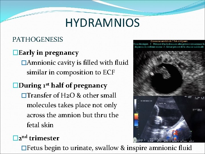 HYDRAMNIOS PATHOGENESIS �Early in pregnancy �Amnionic cavity is filled with fluid similar in composition