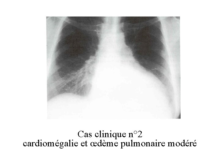 Cas clinique n° 2 C cardiomégalie et œdème pulmonaire modéré 