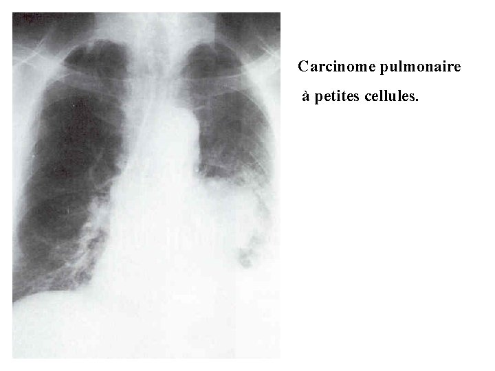 Carcinome pulmonaire à petites cellules. 