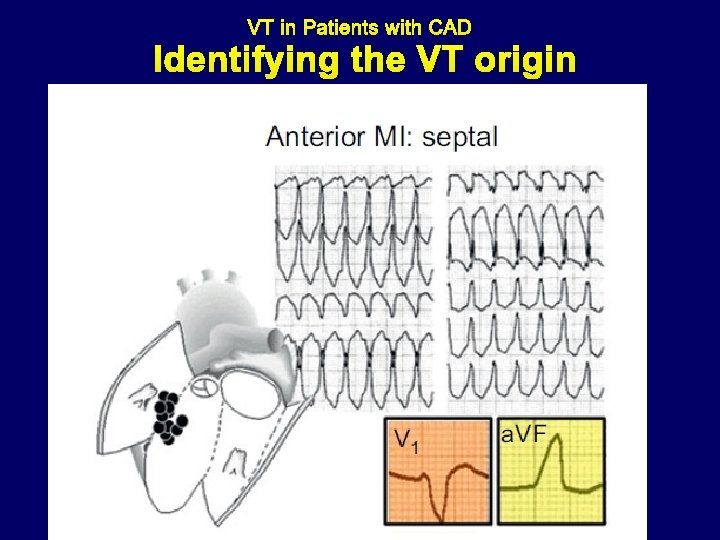 Identifying the VT origin 