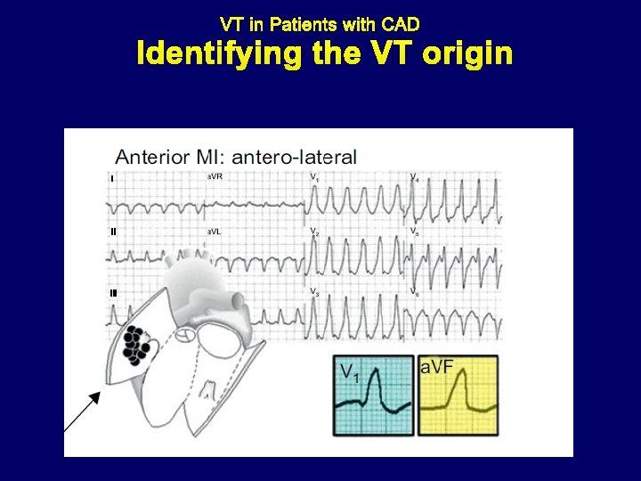 Identifying the VT origin 