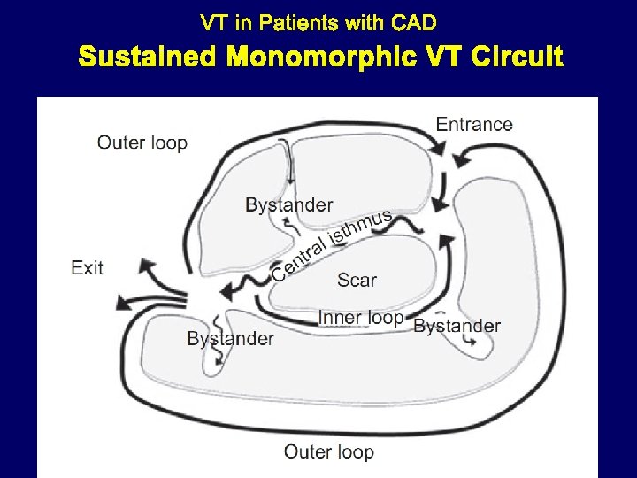 Sustained Monomorphic VT Circuit 