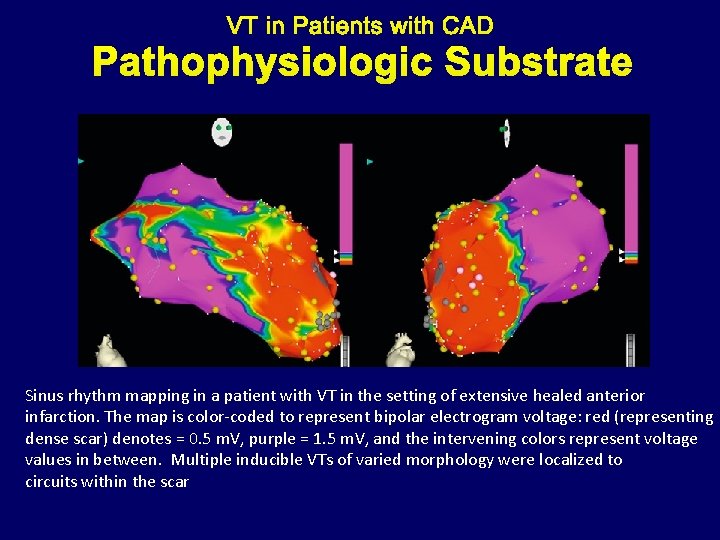 Pathophysiologic Substrate Sinus rhythm mapping in a patient with VT in the setting of