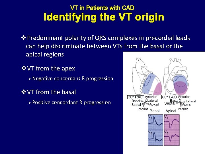 Identifying the VT origin v. Predominant polarity of QRS complexes in precordial leads can