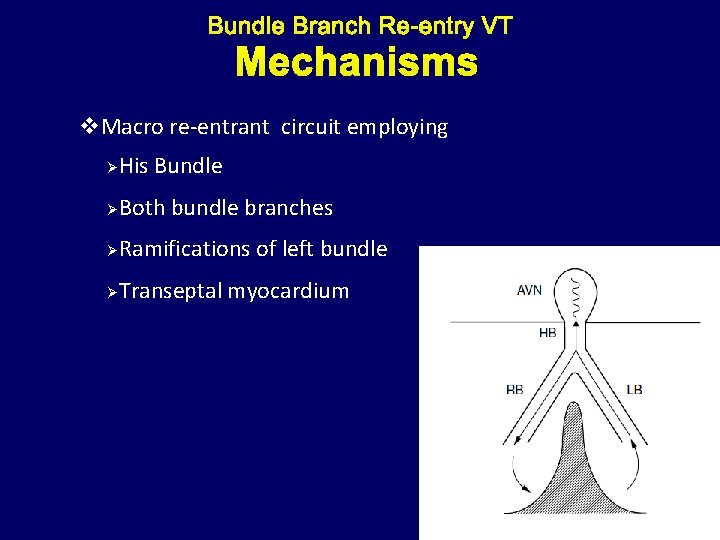 Mechanisms v. Macro re-entrant circuit employing Ø His Bundle Ø Both bundle branches Ø