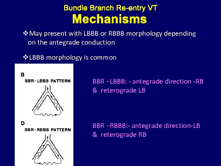 Mechanisms v. May present with LBBB or RBBB morphology depending on the antegrade conduction