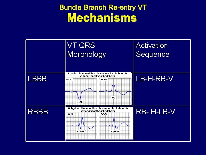 Mechanisms VT QRS Morphology Activation Sequence LBBB LB-H-RB-V RBBB RB- H-LB-V 