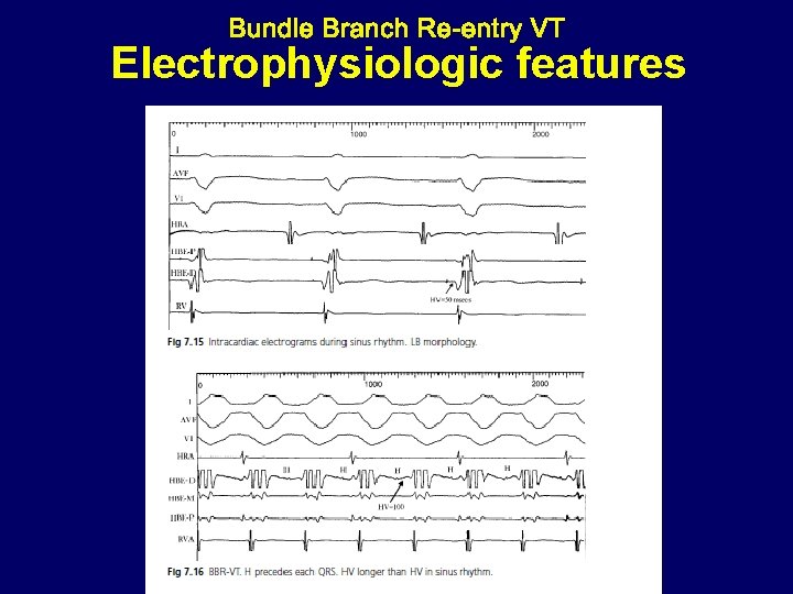 Electrophysiologic features 