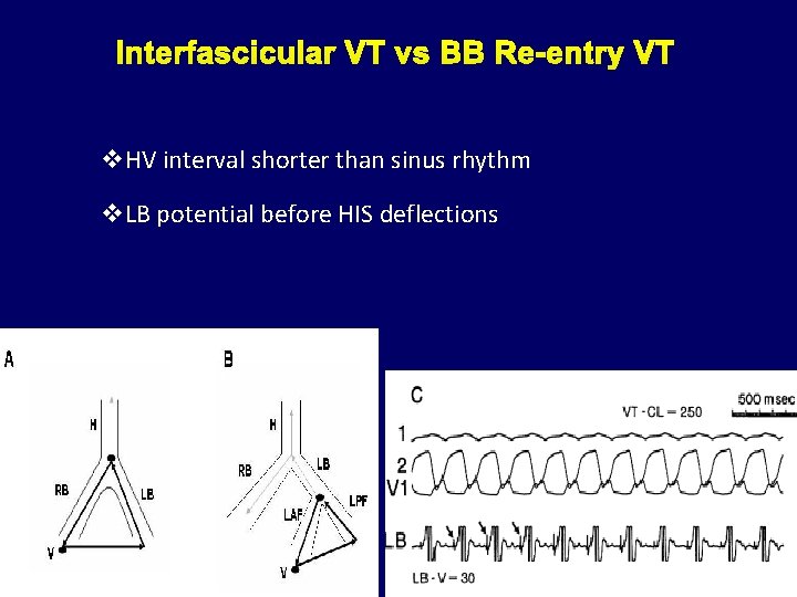 Interfascicular VT v v. HV interval shorter than sinus rhythm v. LB potential before