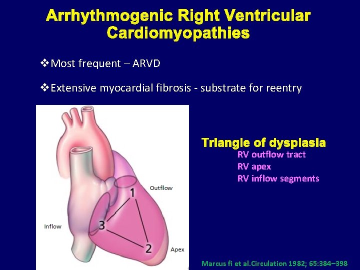 Arrhythmogenic Right Ventricular Cardiomyopathies v. Most frequent – ARVD v. Extensive myocardial fibrosis -