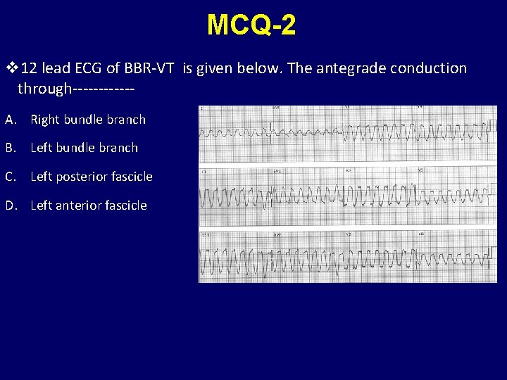 MCQ-2 v 12 lead ECG of BBR-VT is given below. The antegrade conduction through------A.