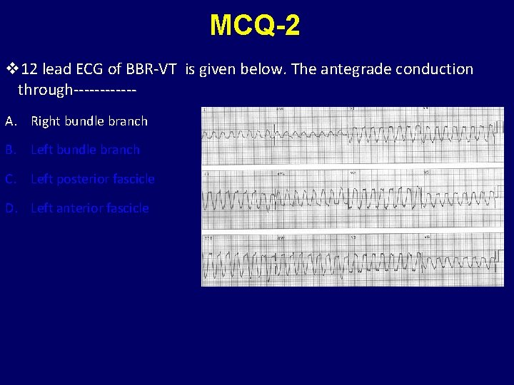 MCQ-2 v 12 lead ECG of BBR-VT is given below. The antegrade conduction through------A.
