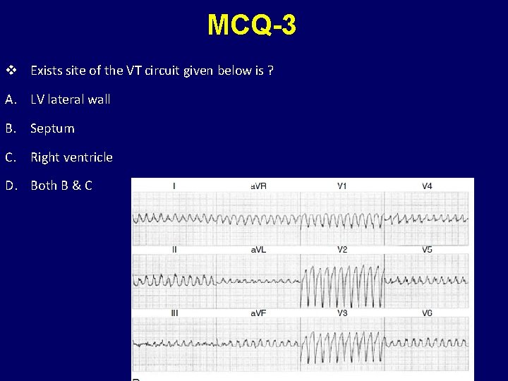 MCQ-3 v Exists site of the VT circuit given below is ? A. LV