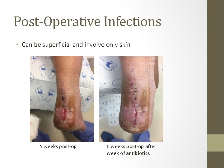 Post-Operative Infections • Can be superficial and involve only skin 5 weeks post-op 6