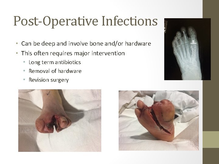 Post-Operative Infections • Can be deep and involve bone and/or hardware • This often