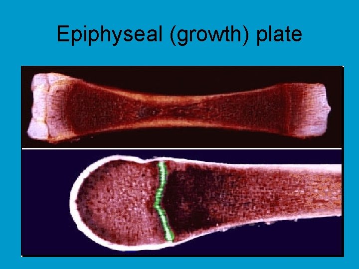 Epiphyseal (growth) plate 