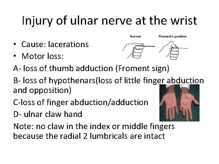 Injury of ulnar nerve at the wrist • Cause: lacerations • Motor loss: A-