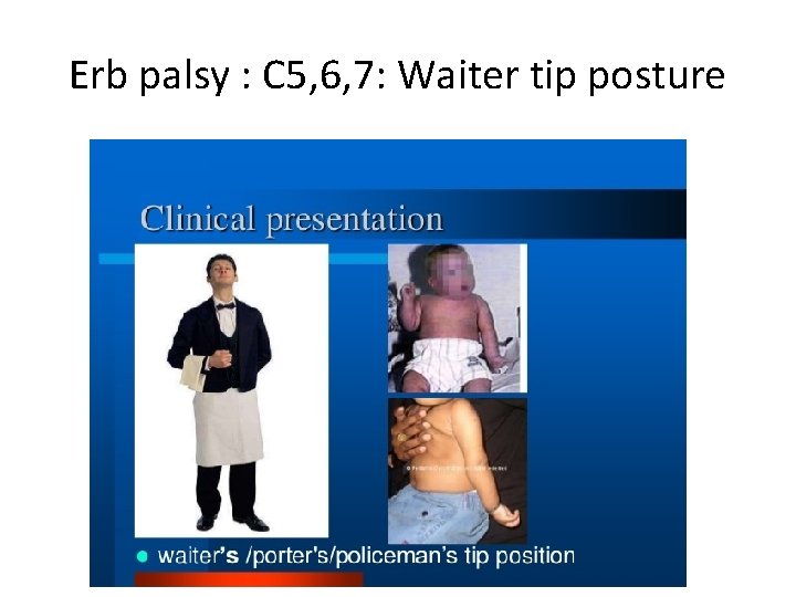 Erb palsy : C 5, 6, 7: Waiter tip posture 