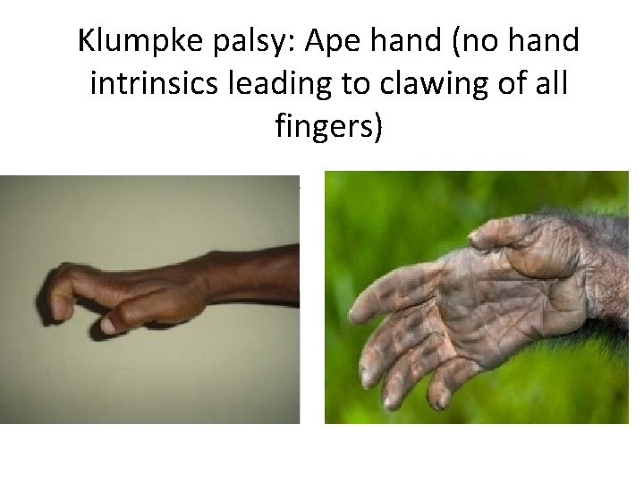 Klumpke palsy: Ape hand (no hand intrinsics leading to clawing of all fingers) 