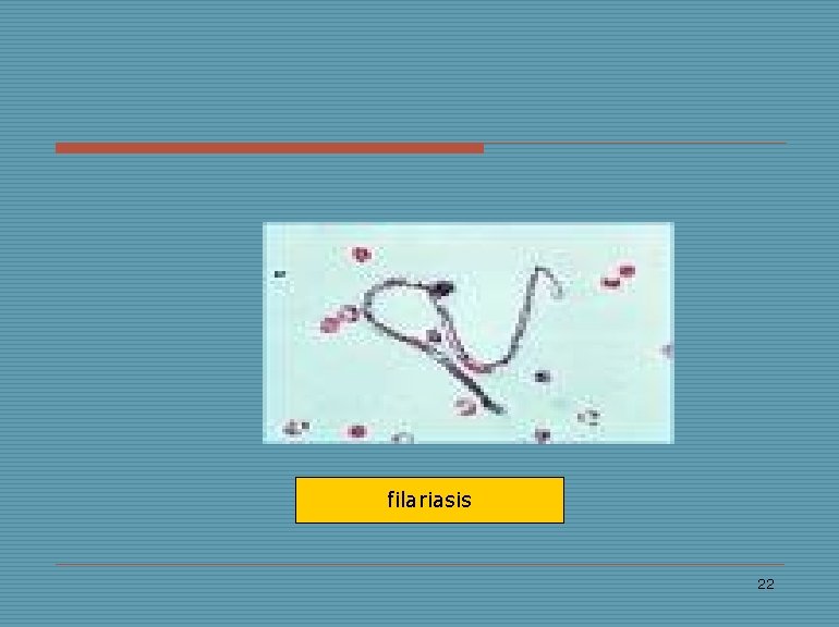 filariasis 22 