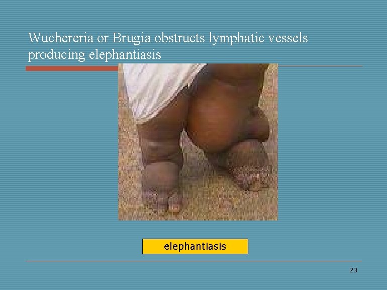 Wuchereria or Brugia obstructs lymphatic vessels producing elephantiasis 23 