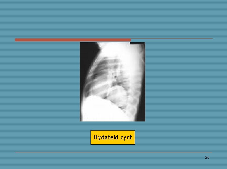 Hydateid cyct 26 