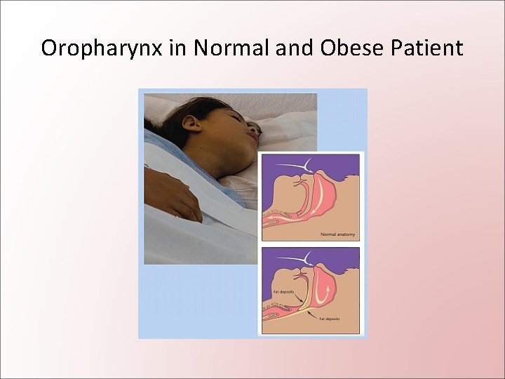 Oropharynx in Normal and Obese Patient 