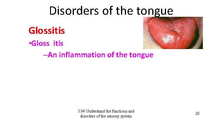 Disorders of the tongue Glossitis • Gloss itis –An inflammation of the tongue 3.