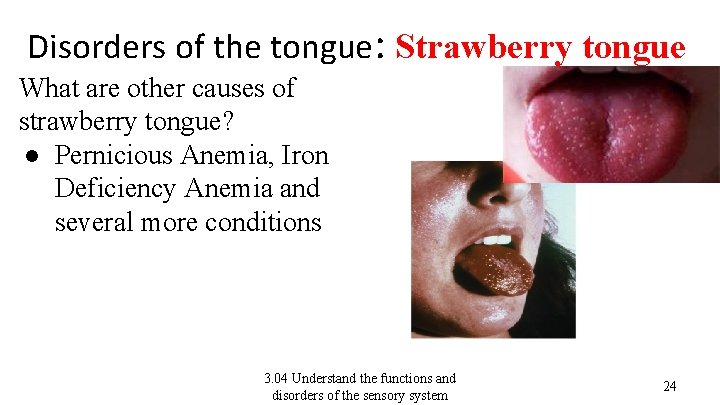 Disorders of the tongue: Strawberry tongue What are other causes of strawberry tongue? ●