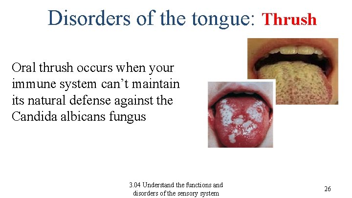 Disorders of the tongue: Thrush Oral thrush occurs when your immune system can’t maintain