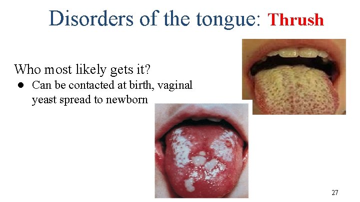 Disorders of the tongue: Thrush Who most likely gets it? ● Can be contacted