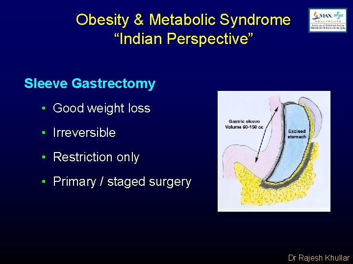 Obesity & Metabolic Syndrome “Indian Perspective” Sleeve Gastrectomy • Good weight loss • Irreversible