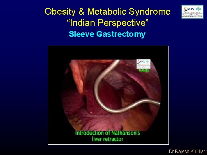 Obesity & Metabolic Syndrome “Indian Perspective” Sleeve Gastrectomy Dr Rajesh Khullar 