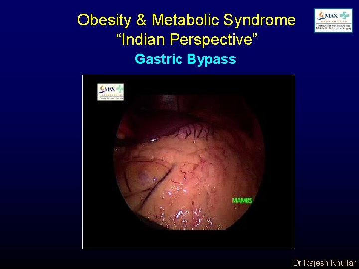 Obesity & Metabolic Syndrome “Indian Perspective” Gastric Bypass Dr Rajesh Khullar 
