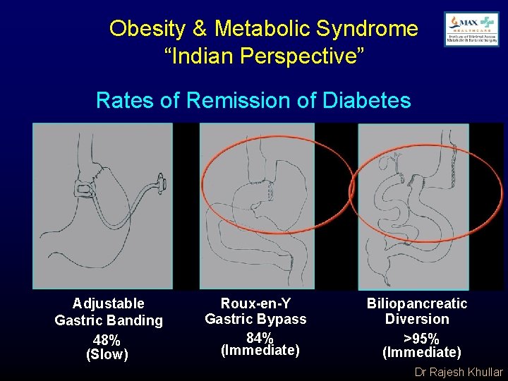 Obesity & Metabolic Syndrome “Indian Perspective” Rates of Remission of Diabetes Adjustable Gastric Banding
