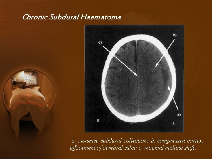 Chronic Subdural Haematoma a, isodense subdural collection; b, compressed cortex, effacement of cerebral sulci;