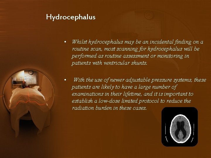 Hydrocephalus • Whilst hydrocephalus may be an incidental finding on a routine scan, most