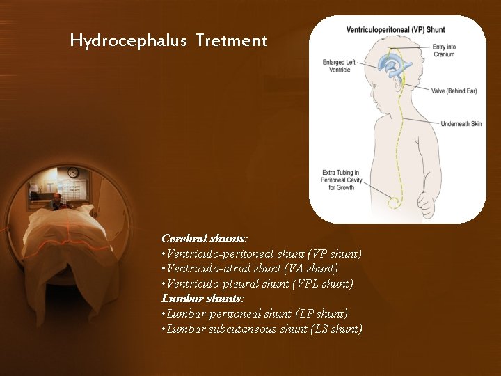 Hydrocephalus Tretment Cerebral shunts: • Ventriculo-peritoneal shunt (VP shunt) • Ventriculo-atrial shunt (VA shunt)
